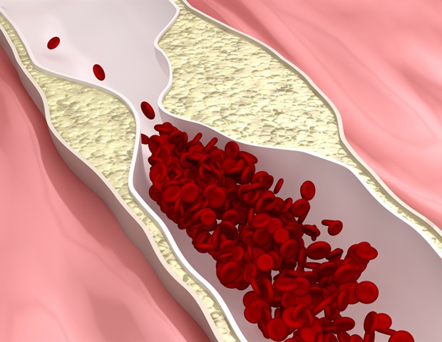 Biodegradable nanomaterials can take photos and ship medication to fight peripheral arterial illness