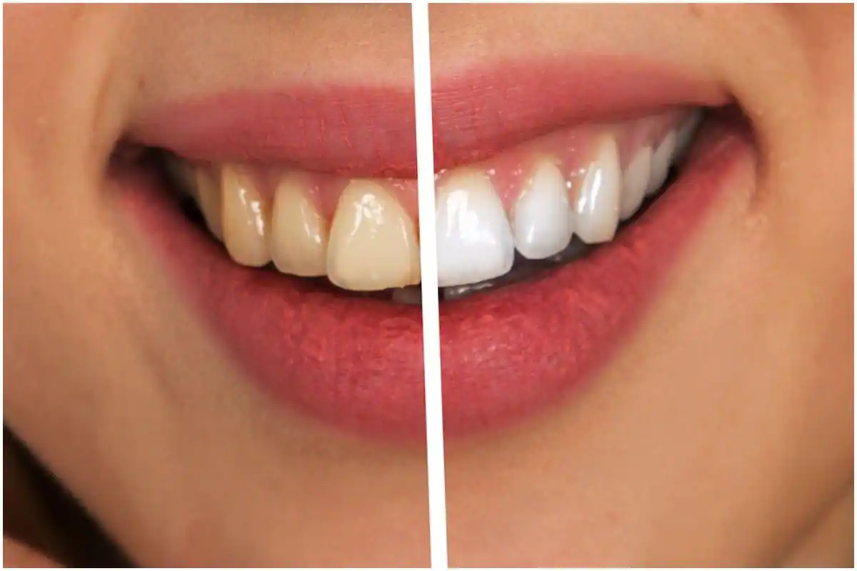 Easy Dental Health Tips: Natural Tooth Whitening Remedies to Use at Home