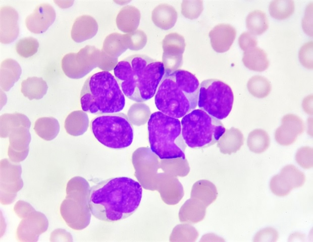 Promising outcomes of mixture therapy for acute myeloid leukemia to be introduced at ASCO 2022