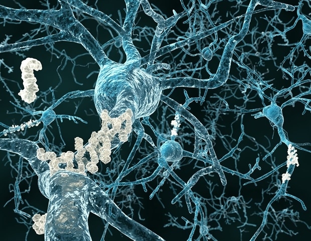 Newly identified mechanism may explain why women are more vulnerable to Alzheimer’s disease