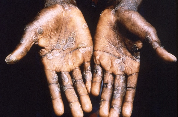 Monkeypox Outbreak Makes Its Way To Milwaukee With Recent Confirmed Case