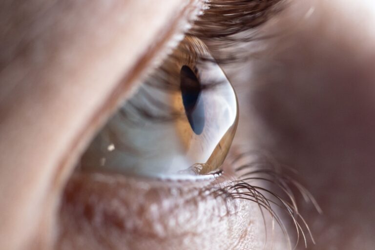 Bioengineered corneal tissue implantation restores vision in advanced keratoconus