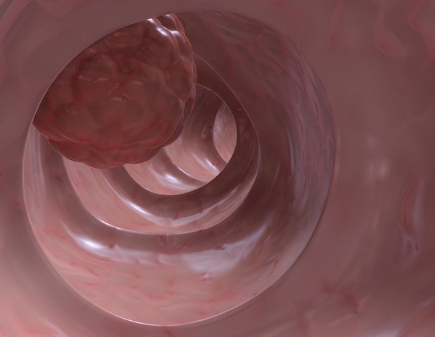 Optical coherence tomography combined with machine learning to develop colorectal cancer imaging tool