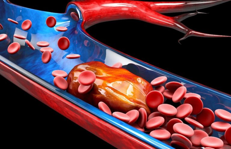 What’s the association between COVID-19 and thrombotic events?