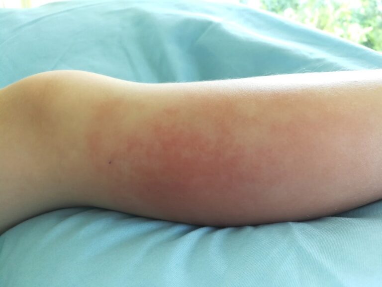 Cellulitis, a deep bacterial infection of the skin, as a monkeypox complication