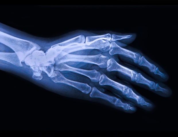 Study finds a possible latest goal to fight osteoarthritis