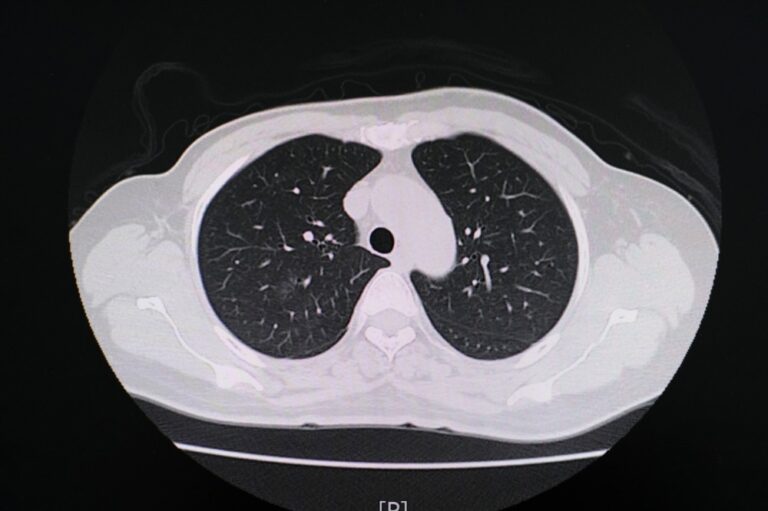 Smoking marijuana damages the lungs greater than tobacco