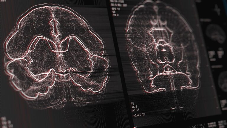 AI won’t replace radiologists, yet!