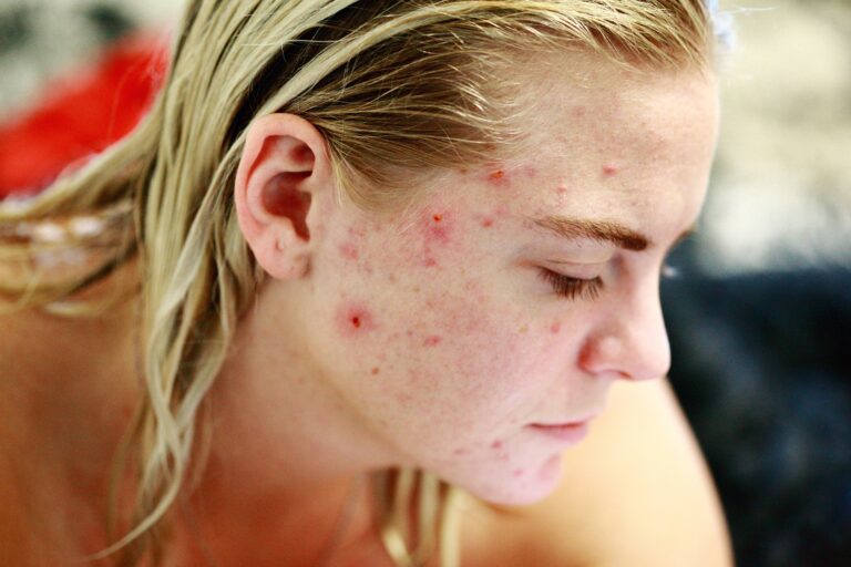 Common Pimples Treatment In Adolescents Can Have Long-Term Effects On Skeletal System: Study