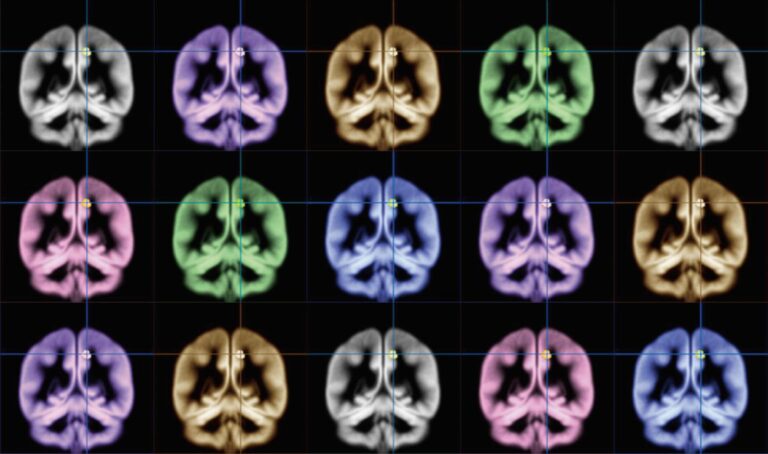 ‘Changes In Almost All Regions Of Brain’