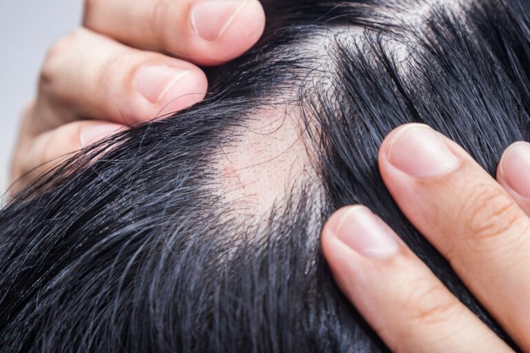 Study links sugary drinks to male hair loss