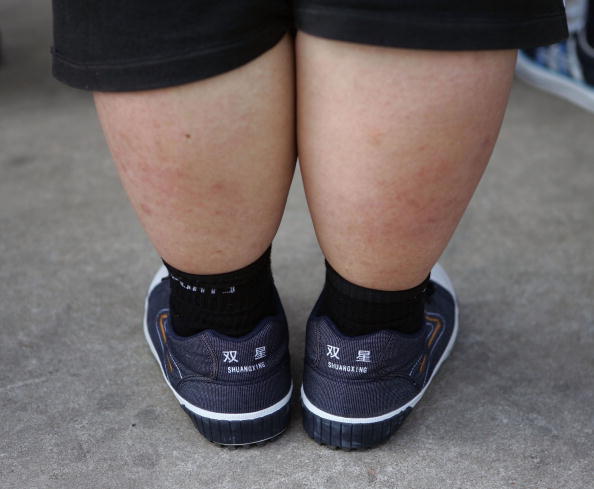 Obesity In Children Linked To Higher Risk Of 4 Latest Subtypes Of Adult-Onset Diabetes