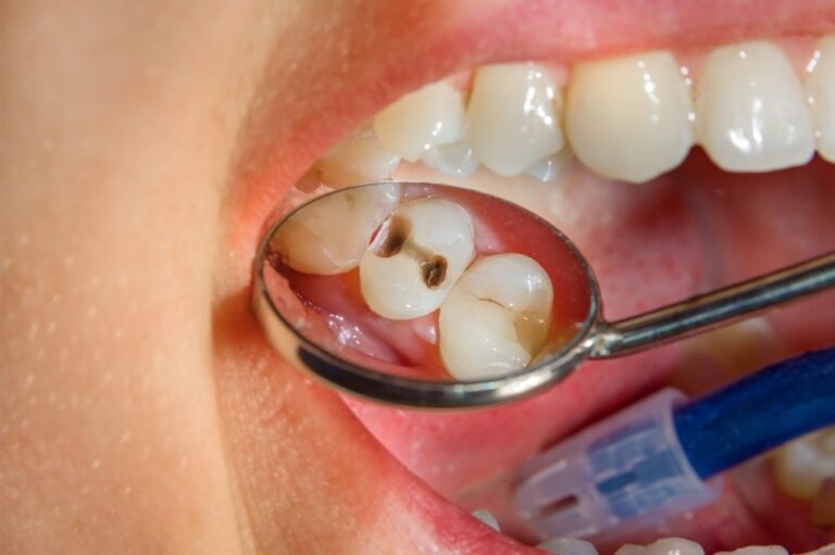 The event of the pediatric oral resistome and its role in dental caries