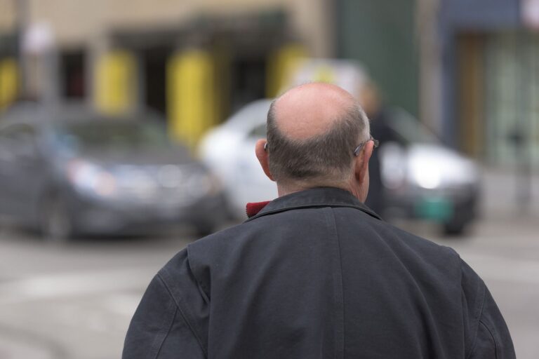 Cure For Baldness In Skin Moles? Scientists Discover Recent Mechanism For Stimulating Hair Growth