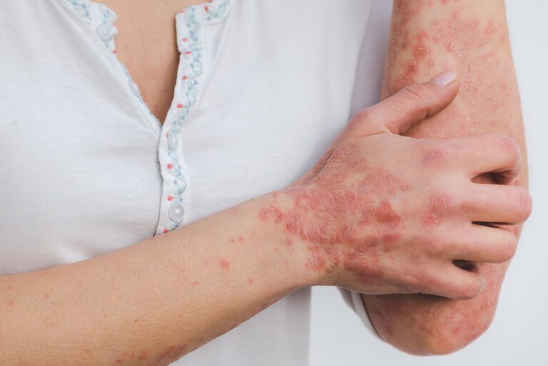 Study Reveals How Psoriasis Inflammation Leads To Other Related Disorders