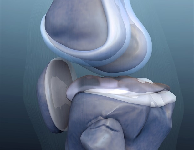 Bilateral total knee arthroplasty may increase risk of complications