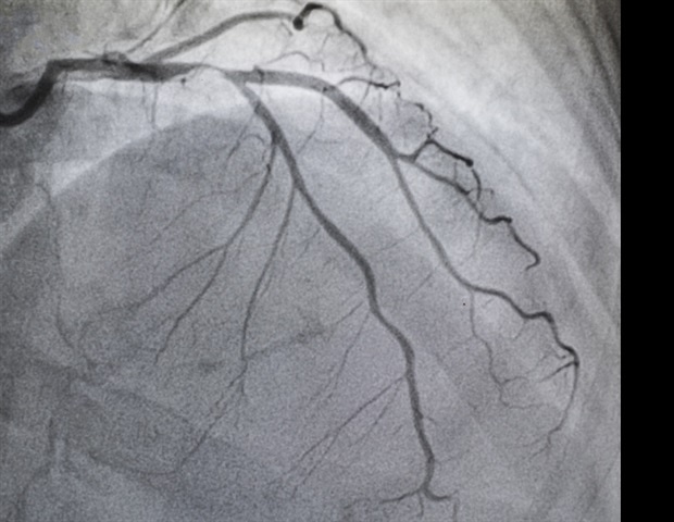 Recent study to judge bleeding complications in patients undergoing high-risk PCI with Impella